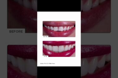 FGM-Opallis-explore-arabic-white444-teeth-dentist